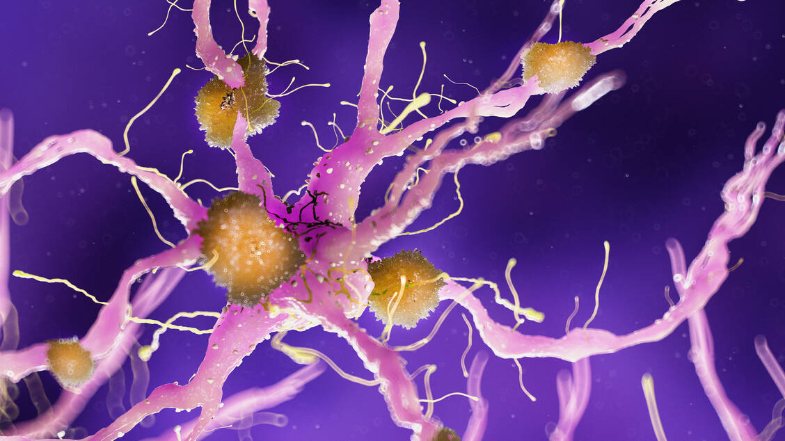 Amyloid-Plaques im Gehirn sind für die Alzheimer-Erkrankung charakteristisch. / Foto: Fotolia/Sebastian Kaulitzki