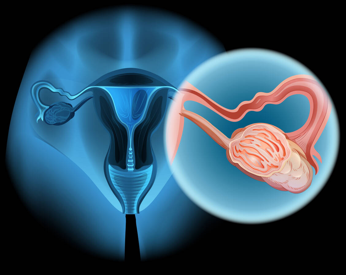 Eierstockkrebs ist eine der häufigsten Todesursachen bei gynäkologischen Krebserkrankungen. Nach Angaben der World Ovarian Cancer Coalition wurde im Jahr 2022 bei mehr als 320.000 Frauen weltweit Eierstockkrebs diagnostiziert. / Foto: Adobe Stock/ blueringmedia