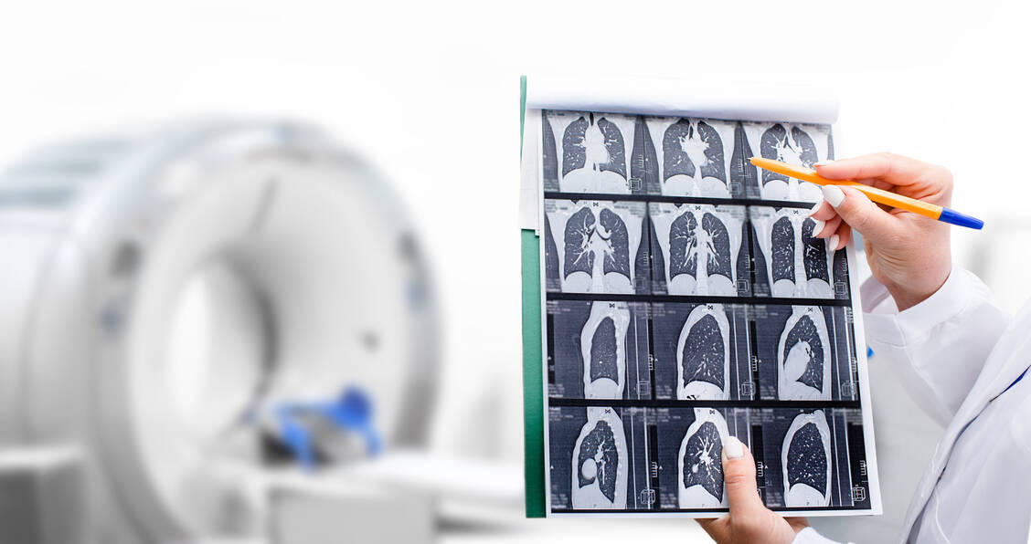 Mit einem Screening auf Lungenkrebs sollen mehr Fälle bereits im Frühstadium entdeckt werden, um die Heilungschancen der Patienten zu verbessern. Es sollen aber nicht alle Personen gescreent werden, sondern nur Raucher. / Foto: Getty Images/Artemenko_Daria