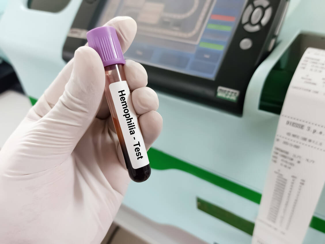 Für die Beurteilung von Störungen der Hämostase ist eine gezielte Diagnostik unabdingbar. / Foto: Adobe Stock/Creative Vault