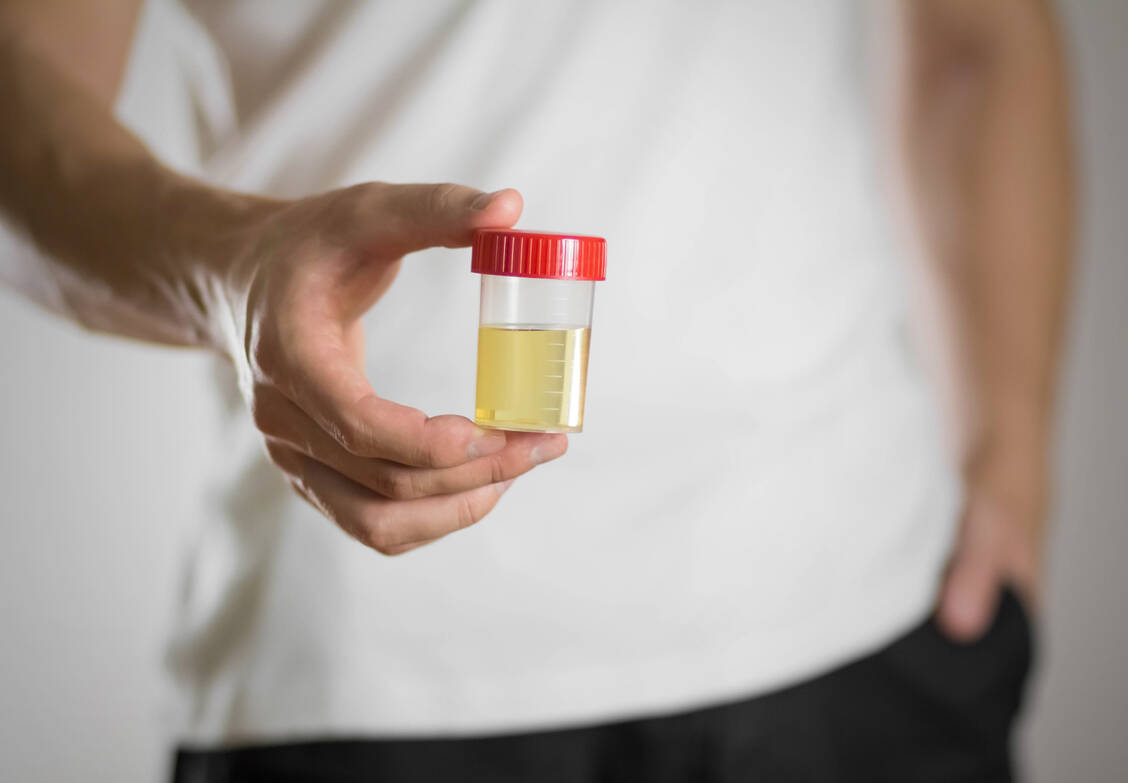 Die Urinanalyse zählt zu den medizinischen Standarduntersuchungen. Auffällige Werte können etwa auf Nieren- oder Stoffwechselerkrankungen hindeuten. / Foto: Adobe Stock/OB production