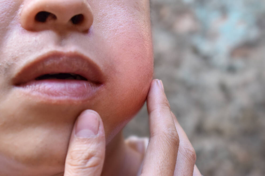 Mumps oder »Ziegenpeter« ist die bekannteste viral ausgelöste Speicheldrüsenentzündung; meist schwillt einseitig eine Ohrspeicheldrüse an. / Foto: Adobe Stock/ZayNyi