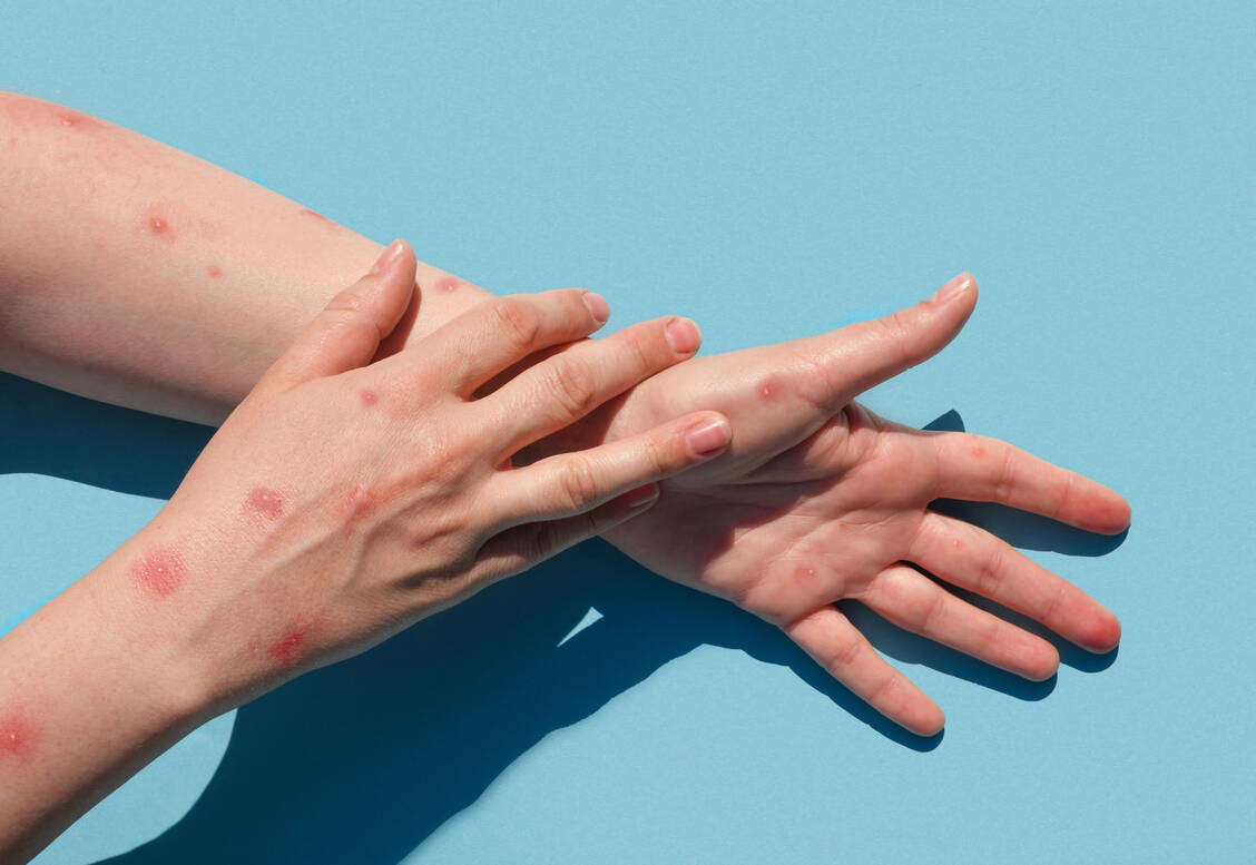 Affenpocken rufen nach etwa fünf Tagen Hautausschläge hervor.  / Foto: Adobe Stock/Marina Demidiuk