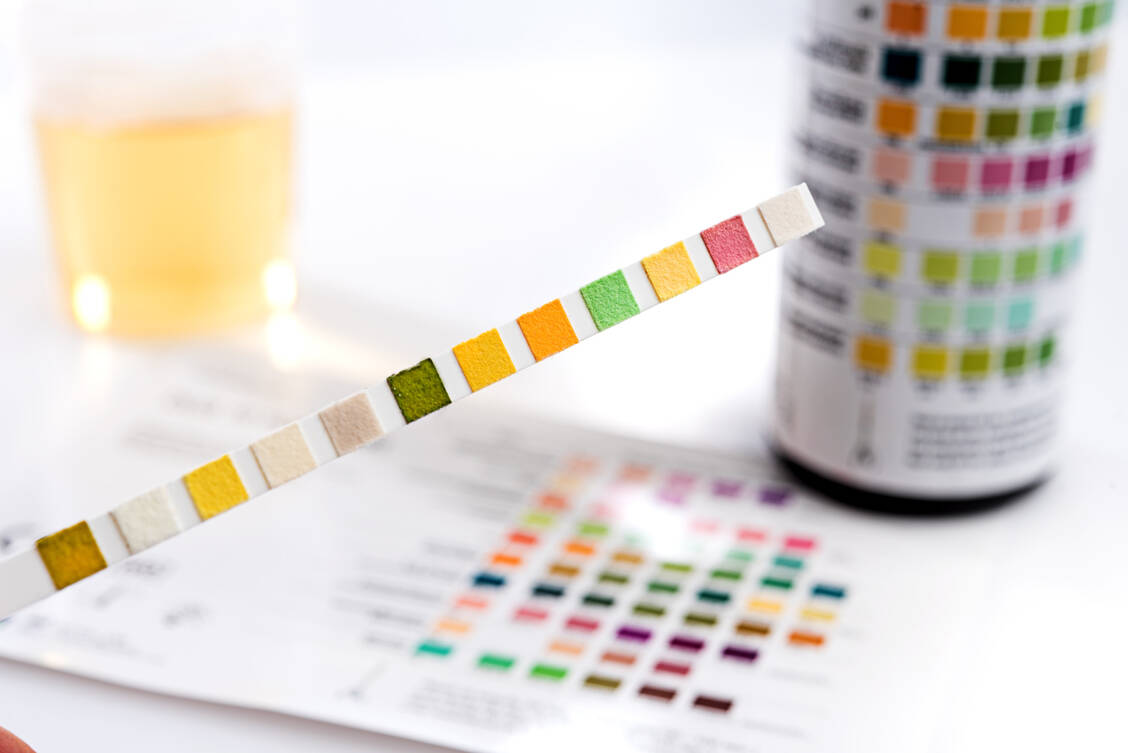 Ob sich Albumin oder Erythrozyten im Urin befinden, lässt sich mithilfe von speziellen Teststreifen herausfinden. / Foto: Adobe Stock/L. Drechsel