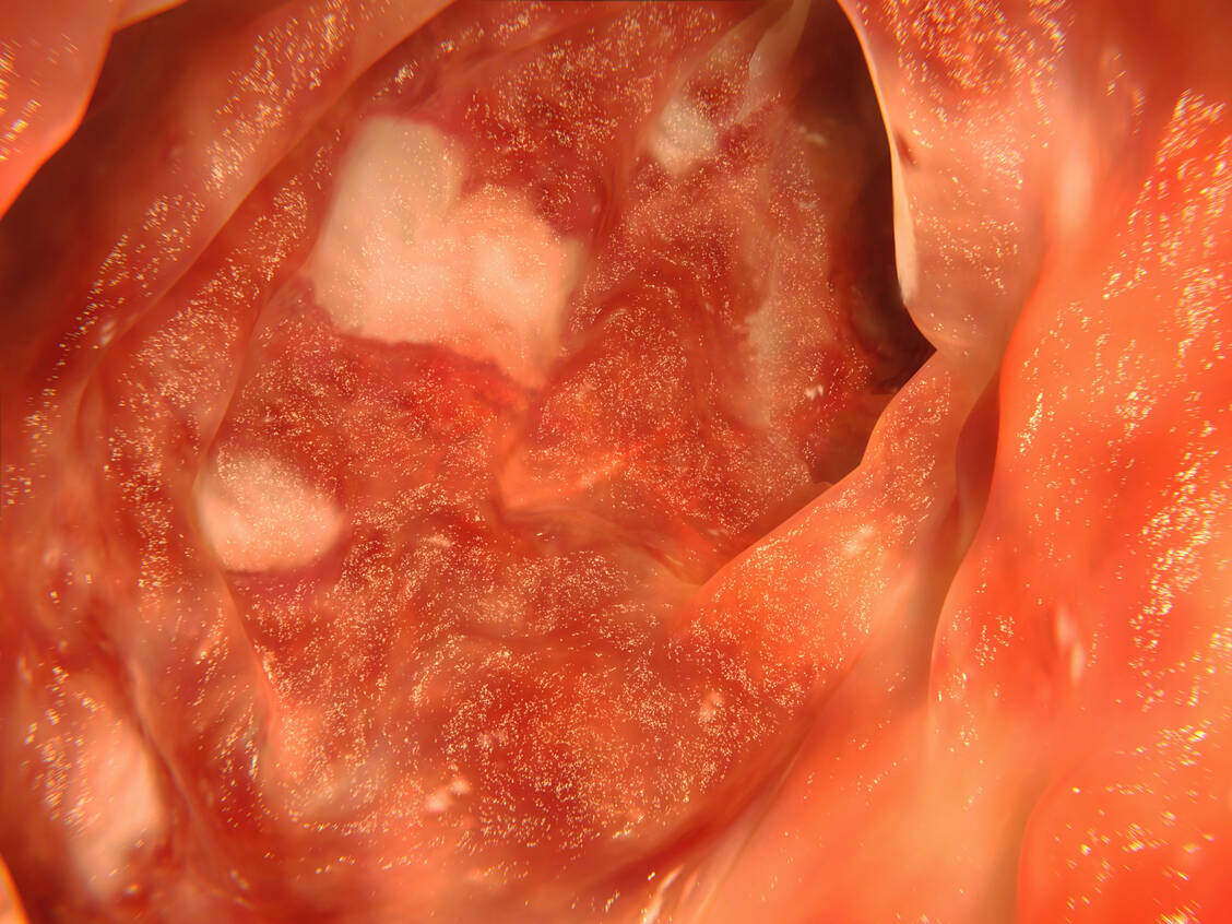 Eine Colitis ulcerosa ist durch Entzündungen der Schleimhaut des Dickdarms gekennzeichnet, die schubweise verläuft. / © Getty Images/selvanegra