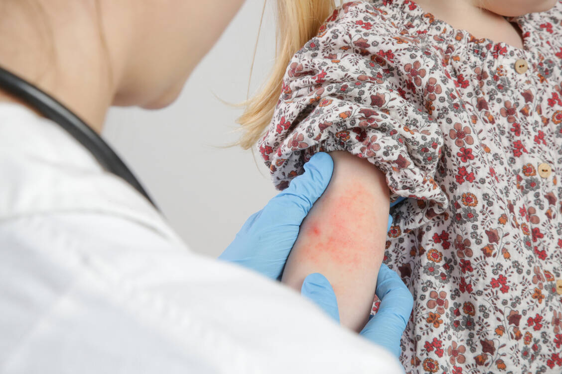 In Deutschland leiden schätzungsweise zwei Millionen Kinder und Jugendliche an Neurodermitis. Die 12-Monats-Prävalenz ist im Säuglings- und Kleinkindalter am höchsten, der Leidensdruck sehr groß. / Foto: Getty Images/triocean