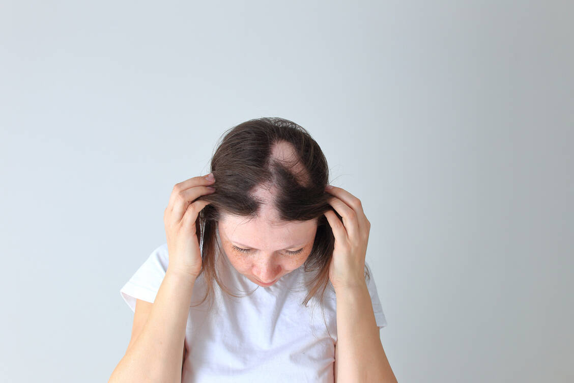 Die meisten Betroffenen von Alopecia areata verlieren zum ersten Mal in ihren Zwanzigern stellenweise ganze Haarbüschel.  / Foto: Adobe Stock/Nadya Kolobova