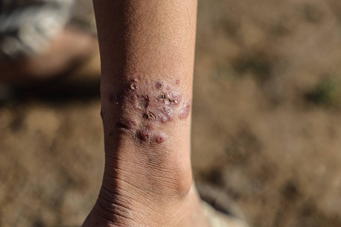 Leishmaniasis-Fälle treten in Südeuropa, den Tropen und Subtropen auf. Infektionen werden aber auch zunehmend bei Reiserückkehrern aus dem europäischen Mittelmeerraum einschließlich Mallorca beobachtet. / © Imago/Anadolu Agency