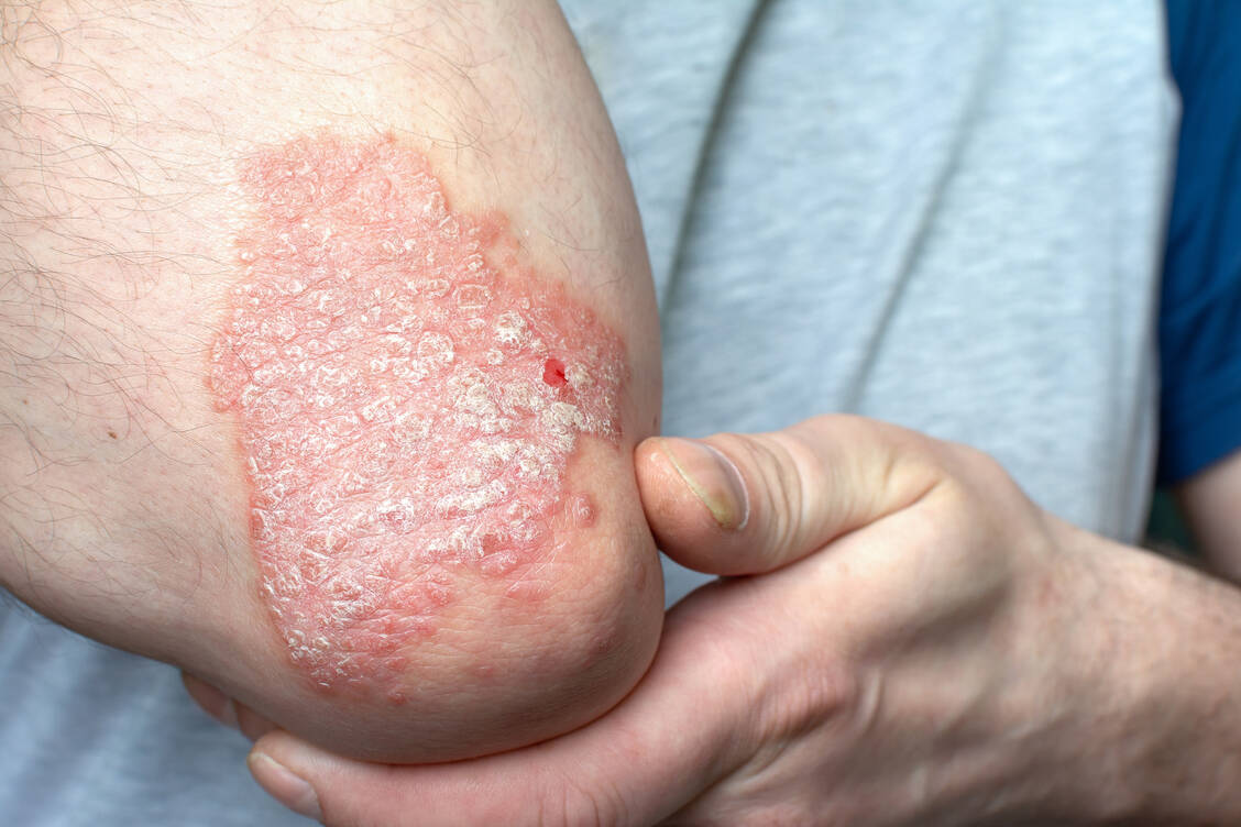 Die Psoriasis vulgaris oder Plaque-Psoriasis ist die häufigste Form der Schuppenflechte. / Foto: Adobe Stock/Denis Klimov