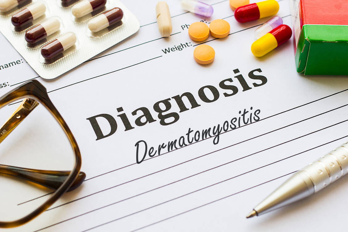 Die seltene systemische Autoimmunerkrankung Dermatomyositis zählt zur Gruppe der idiopathischen inflammatorischen Myopathien. Entzündliche Prozesse greifen dabei vor allem die Skelettmuskulatur an, führen aber auch zu typischen Hautmanifestationen. / © Getty Images/Marcelo Ricardo Daros