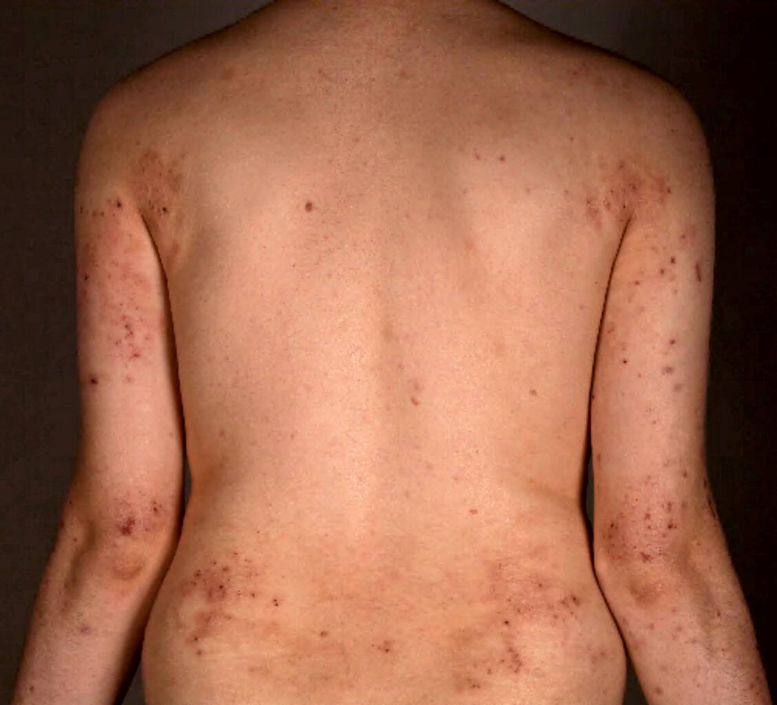 Bei schwerer Ausprägung werden auch systemische Immunmodulatoren eingesetzt. / Foto: Dermatologische Klinik, USZ