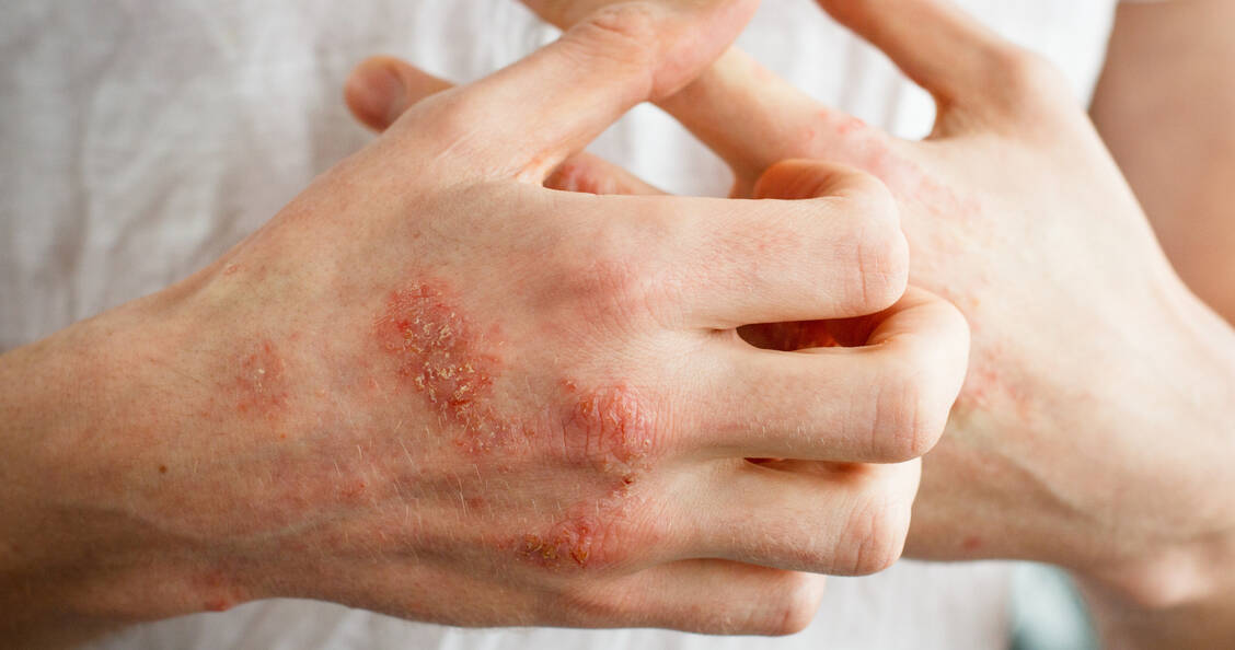 Das Hautbild einer Plaque-Psoriasis kann sich unter einer bestehenden Therapie verschlechtern. Stress gehört zu den wichtgisten Triggern für eine Verschlechterung. / Foto: Adobe Stock/Olga Ternavskaia