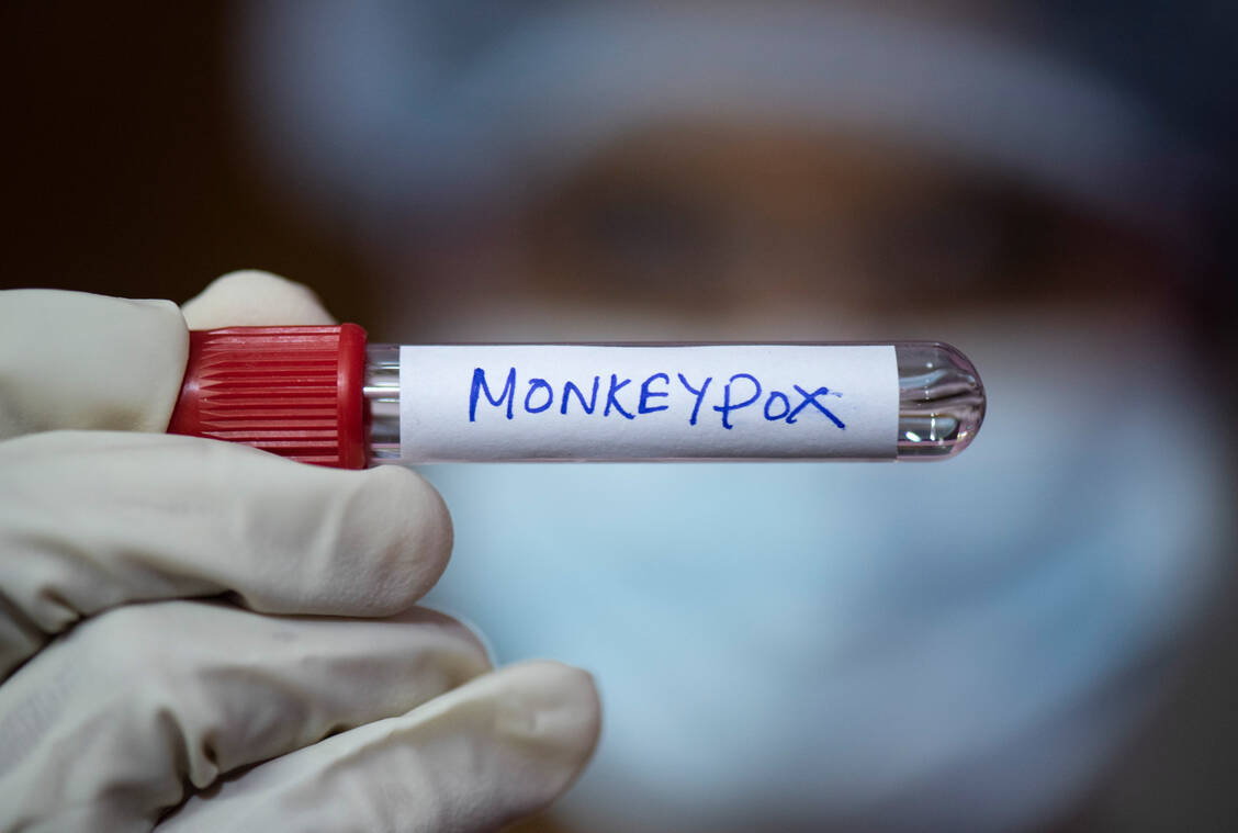 Das Mpox-Virus hieß früher Affenpocken-Virus (Monkeypox virus). Um eine Stigmatisierung Infizierter zu vermeiden, wurde der Name geändert. / © Getty Images/David Talukdar