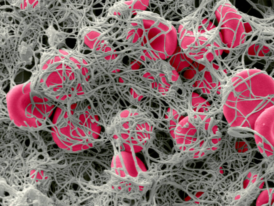 Mit Fibrin (grau) verklumpte Erythrozyten (rot) bilden einen Thrombus. Löst der Körper Fibrin auf, entstehen D-Dimere. Sie sind bei Covid-19-Patienten erhöht. / Foto: Getty Images/Science Photo Library/Steve Gschmeissner