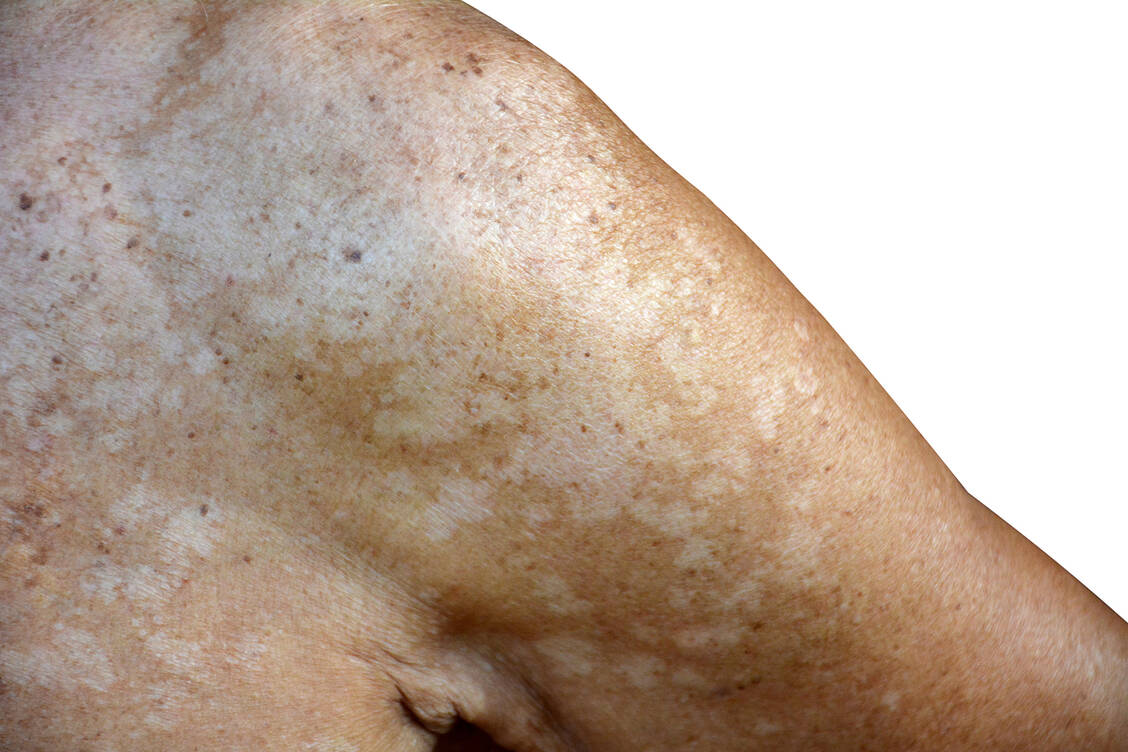 Der lipophile Hefepilz Malassezia furfur, der natürlicherweise die Haarfollikel besiedelt, kann als Pathogen bräunlich pigmentierte Pilzrasen, zum Beispiel auf Kopfhaut und Oberkörper, bilden. / Foto: Adobe Stock/buraratn_100