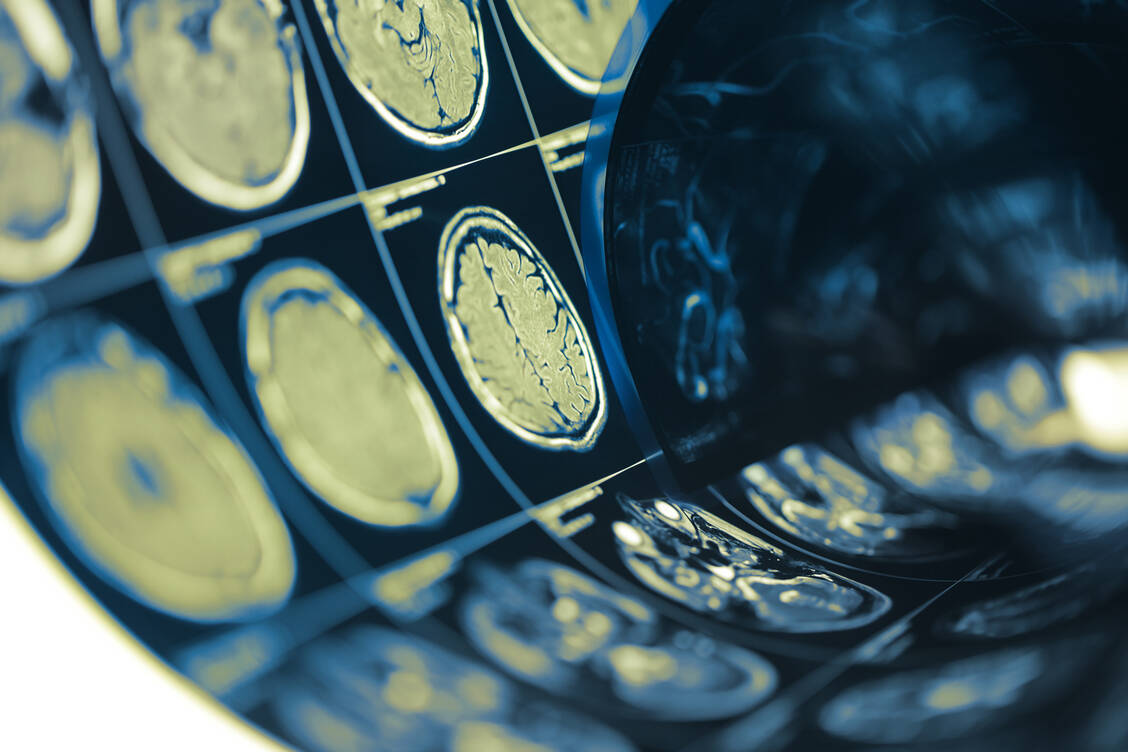 Ein Meningeom ist ein gutartiger Tumor der Hirnhaut. Möglicherweise erhöhen die beiden Gestagene Nomegestrol und Chlormadinon das Erkrankungsrisiko. / Foto: Shutterstock/sfam_photo