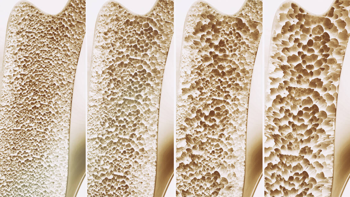 Im Knochen finden lebenslang Umbauprozesse statt. Ungefähr mit 35 Jahren ist die maximale Knochendichte erreicht, danach überwiegt der Knochenabbau. / Foto: Adobe Stock /crevis