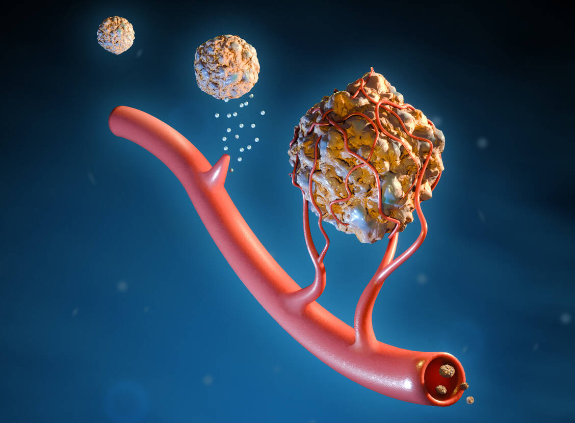 Über Gefäßneubildung stellen Tumoren ihre Versorgung mit Sauerstoff und Nährstoffen sicher. Diesen Weg zu kappen, ist ein bewährtes Therapieprinzip vieler Arzneistoffe. Auch der Neuling Fruquintinib greift hier ein. / Foto: Getty Images/Andrea Danti