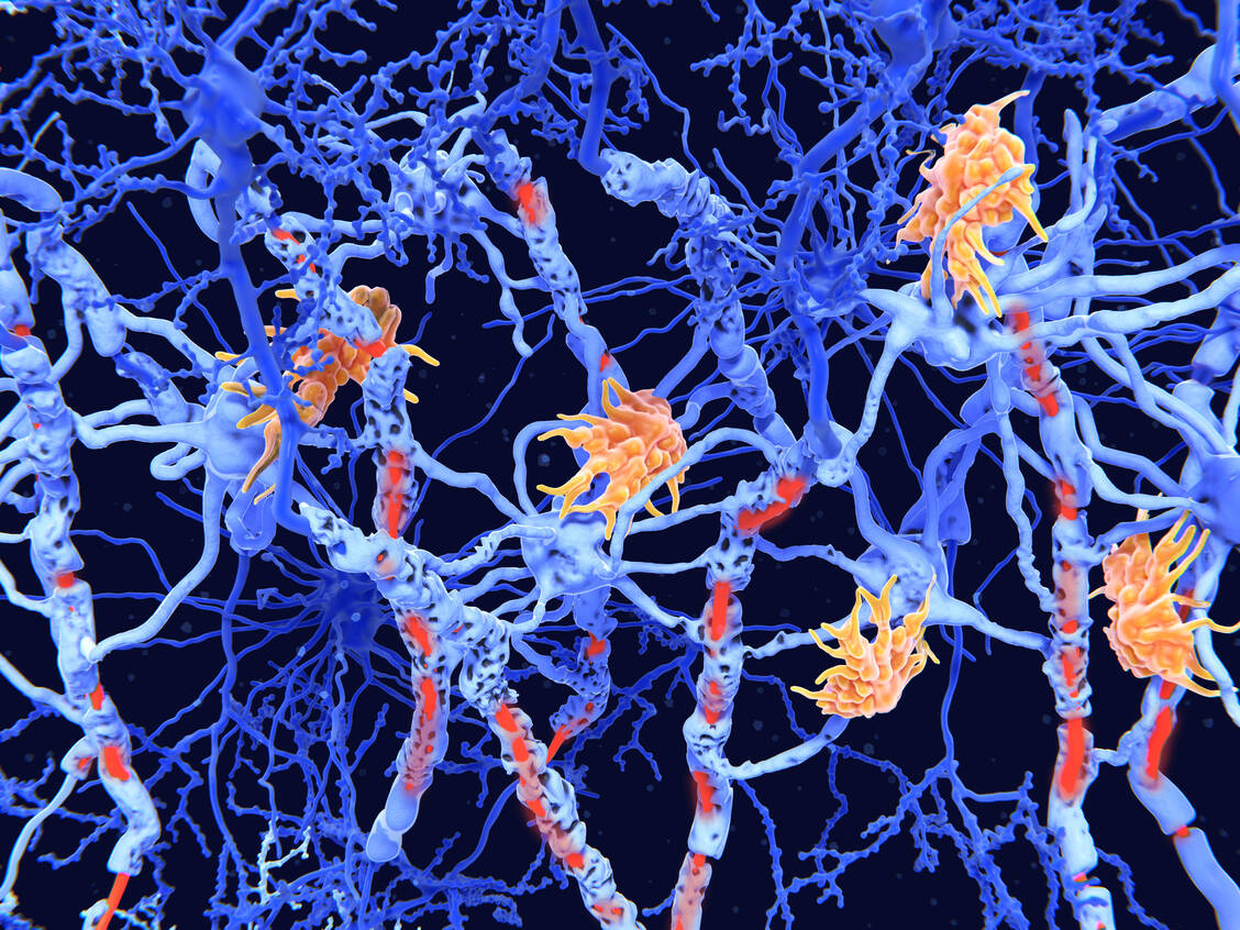 Bei MS greift das Immunsystem die Myelinscheiden der Nervenzellen an und baut sie ab. Durch den Einsatz von Immunmodulatoren soll das verhindert werden. / Foto: Getty Images/Juan Gärtner/Science Photo Library