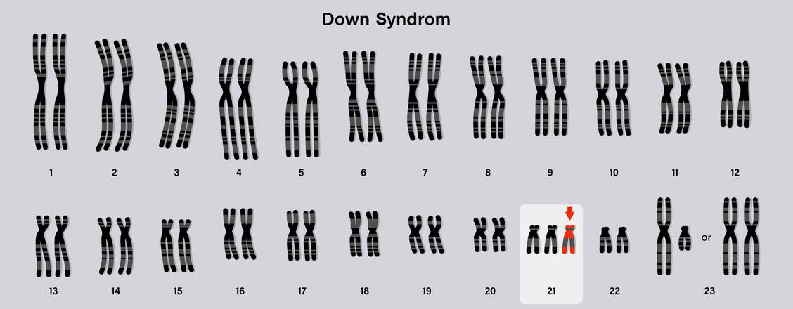 Bei Trisomie 21 liegen das gesamte Chromosom 21 oder Teile davon nicht zweifach, sondern dreifach vor. / © Shutterstock/Dee-sign