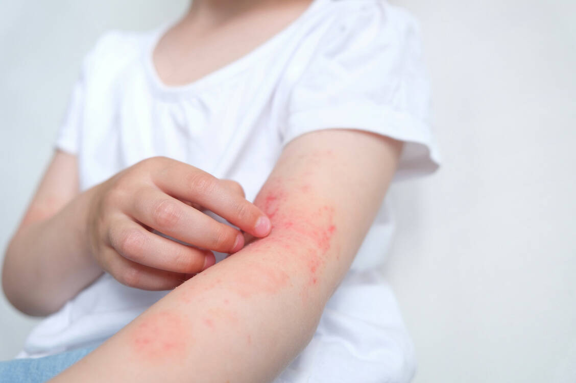 In der Behandlung der atopischen Dermatitis sind in den vergangenen Jahren große Fortschritte erzielt worden. Allerdings gibt es noch weiteren Bedarf an neuen Therapieoptionen für Betroffene. / Foto: Adobe Stock/Marina Terekhova
