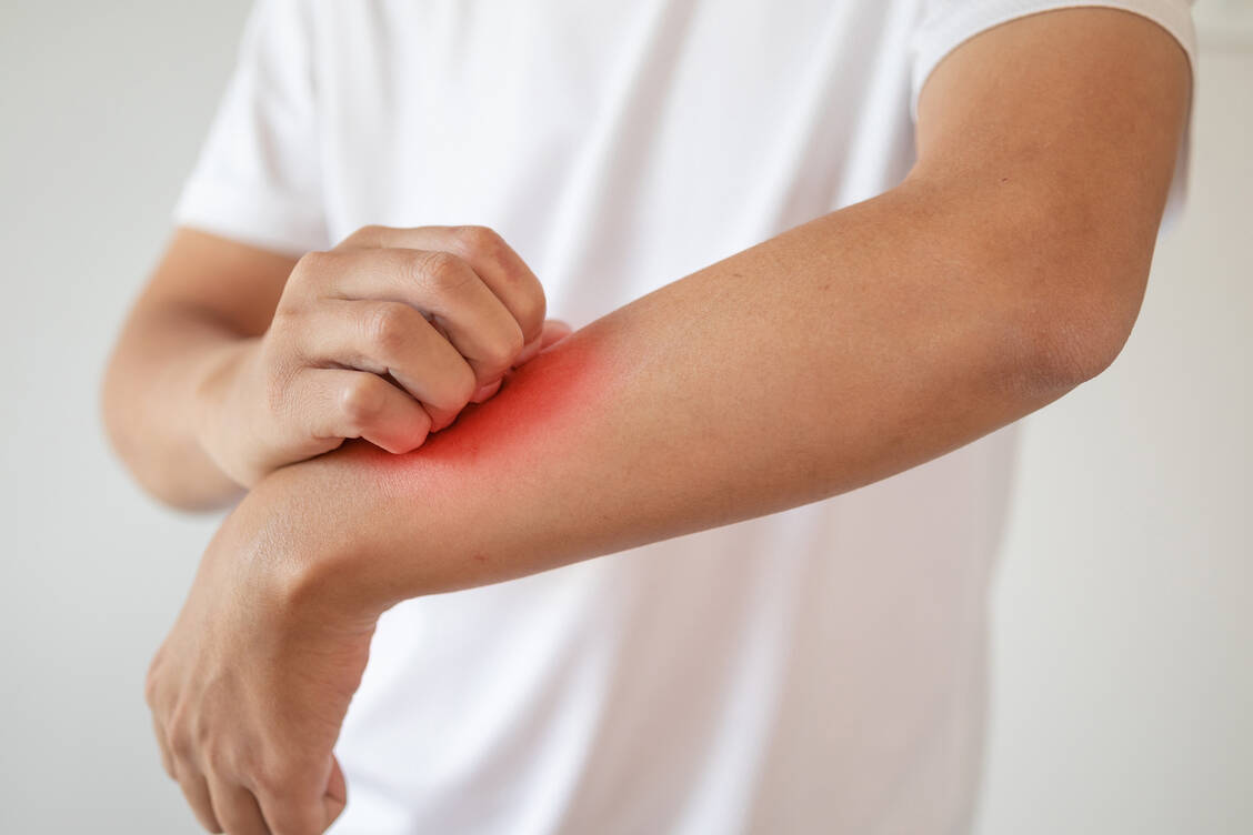 Psoriasis ist eine erblich bedingte, nicht ansteckende chronische Erkrankung mit hohem Leidensdruck. / Foto: Adobe Stock/Piman Khrutmuang