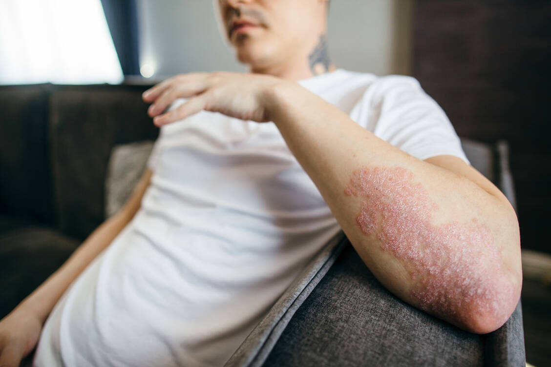 Die Plaque-Psoriasis ist die am häufigsten auftretende Schuppenflechte. Es gibt schon eine Reihe zugelassener Wirkstoffe, unter anderem Antikörper. / © Getty Images/Tanja Ivanova