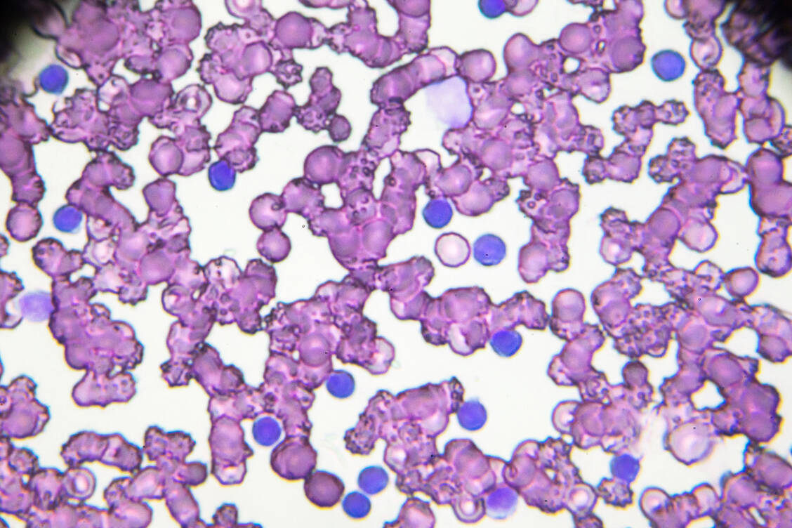 Blutausstrich eines CLL-Patienten unter dem Mikroskop.  / Foto: Getty Images/jxfzsy