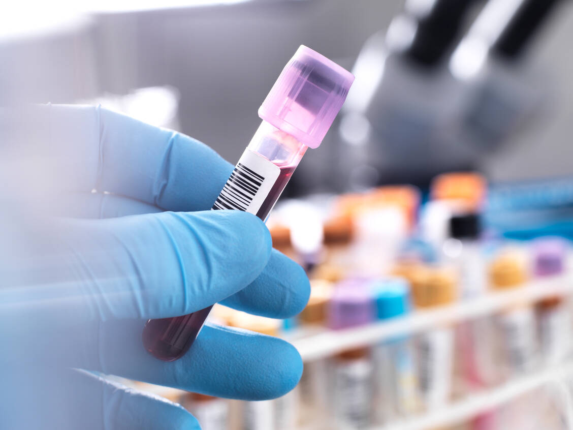 Mithilfe der Lipidomik identifizierte eine Arbeitsgruppe in Blutproben potenzielle Biomarker für Typ-2-Diabetes und Herz-Kreislauf-Erkrankungen. / Foto: Getty Images/Westend61/Andrew Brookes