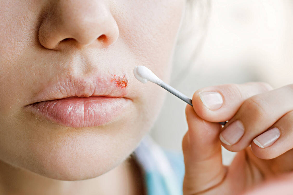 Ohne eine Änderung des EU-Vorschlags werden verschreibungsfreie Arzneimittel, die zur Behandlung von Infektionen mit Lippenherpes (Herpes labiales-Viren, siehe Foto) eingesetzt werden, der Verschreibungspflicht unterstellt. / Foto: Shutterstock/Domaskina