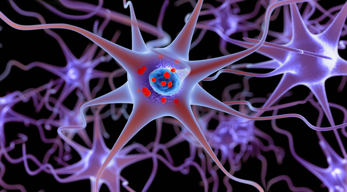 Intrazelluläre Einschlüsse von α-Synuclein, sogenannte Lewy-Körperchen, sind Kennzeichen von Morbus Parkinson und der Lewy-Körperchen-Demenz. / Foto: Getty Images/Lars Neumann