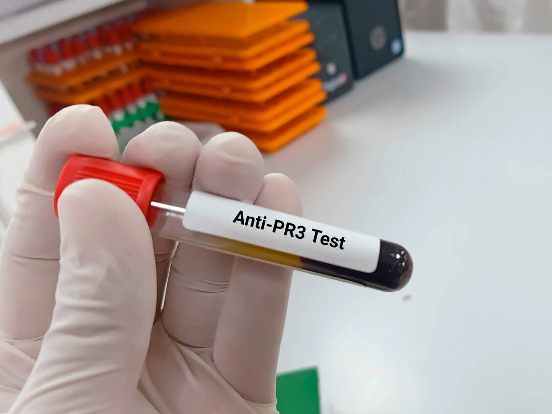 Der Anti-PR3-Test (cANCA-Test) ist ein wesentlicher Bestandteil der Diagnostik der Granulomtatose mit Polyangiitis. Zur Diagnose der mikroskopischen Polyangiitis dient der Anti-MPO-Test (pANCA-Test). Bei Erkrankungen zählen zu den ANCA-Vaskulitiden. / Foto: Shutterstock/Innovative Creation