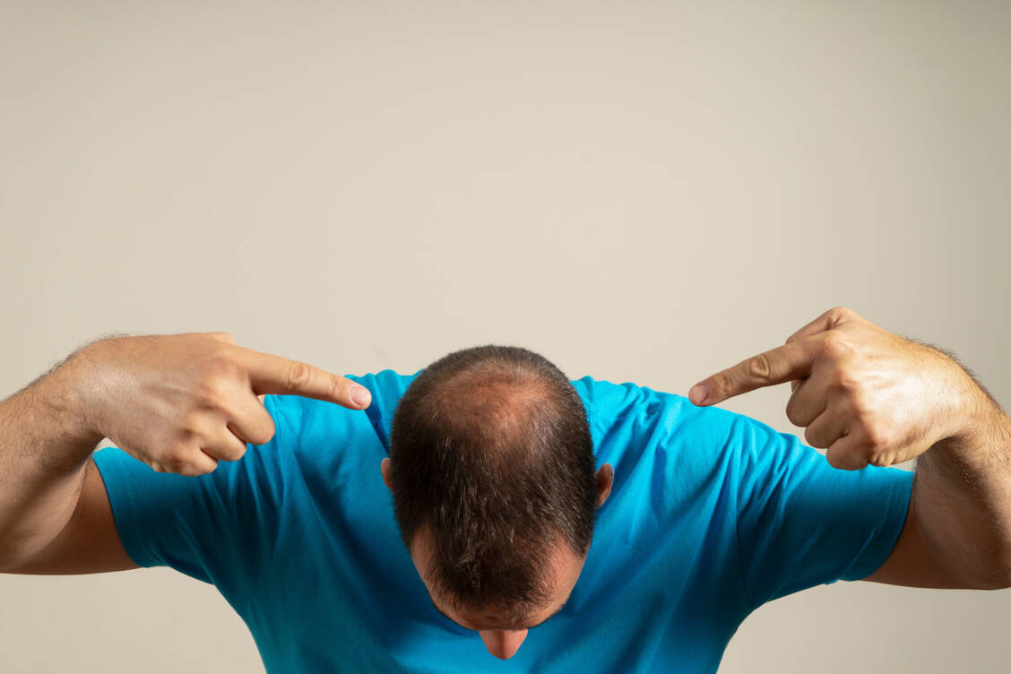 Ursache der androgenetischen Alopezie ist oft eine Überempfindlichkeit der Haarwurzeln gegenüber Dihydrotestosteron. / Foto: Shutterstock/andres barrionuevo lopez