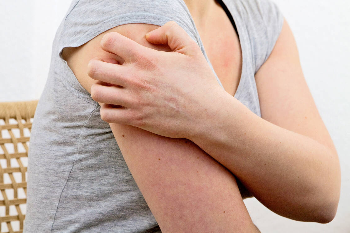 Quälendes Symptom vieler Erkrankungen: andauernder Juckreiz / Foto: dpa/Kai Remmers