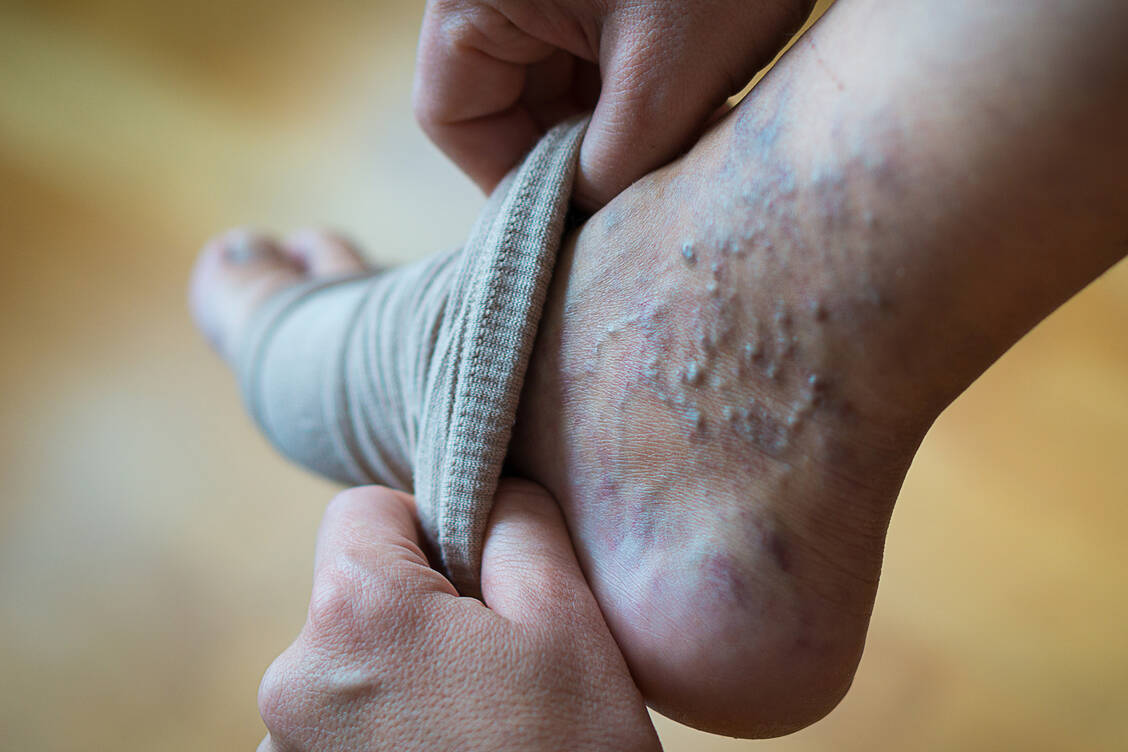 Kompressionsstrümpfe sind bei Krampfadern zwar wirksam, aber bei vielen Patienten unbeliebt. In manchen Fällen könnte auch eine dünne Ummantelung der betroffenen Vene als Therapie infrage kommen. / Foto: Adobe Stock/SergeVo