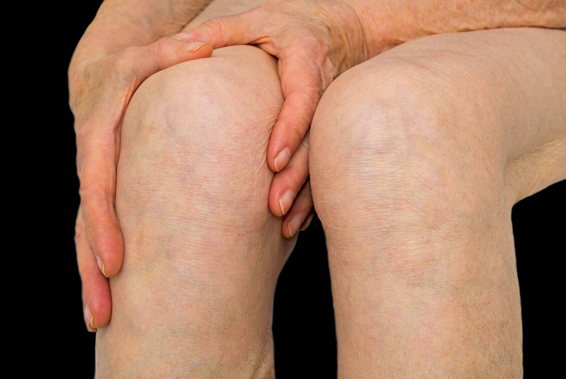 Chronische Schmerzen infolge einer Arthrose sind schwierig zu behandeln. Bei vielen Patienten wird irgendwann ein Gelenkersatz notwendig. / Foto: Shutterstock/Solarisys