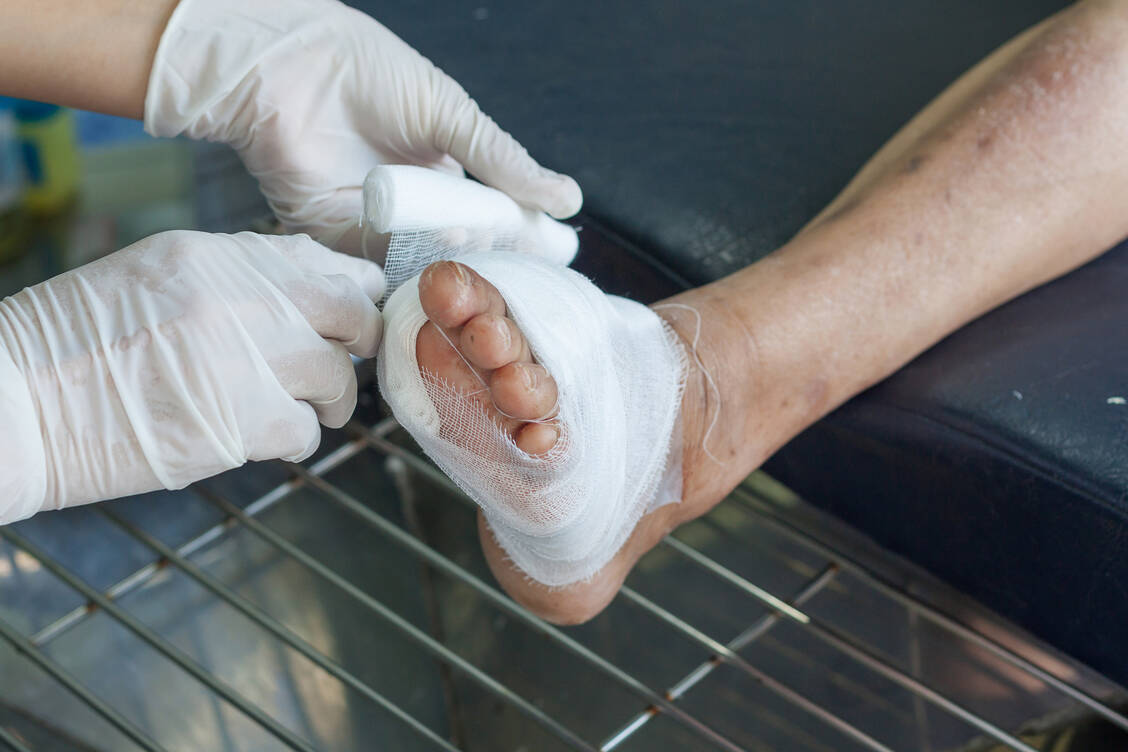 Fast drei Viertel aller Bein-, Fuß- oder Zehenamputationen betreffen Menschen mit Diabetes. Wenn man Wunden verschließt, kann man Amputationen verhindern. / Foto: Adobe Stock/kirov1969