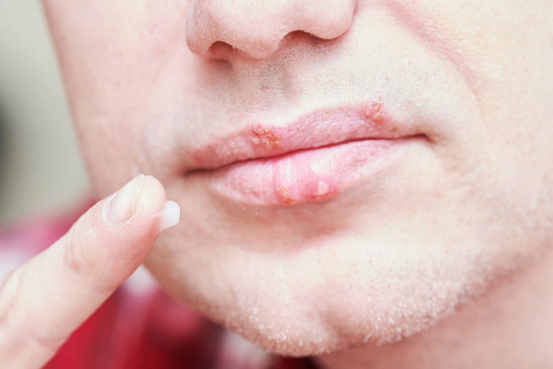 Hier waren die natürlichen Killerzellen des angeborenen Immunsystems wohl nicht schnell genug, und der Lippenherpes konnte aufblühen. / Foto: Adobe Stock/Kadmy