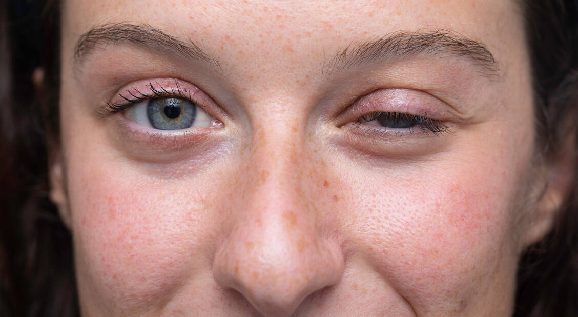 Typisches Symptom der Muskelschwäche-Erkrankung Myasthenia gravis sind unter anderem Lähmungen der Augenmuskulatur und des Lidhebers. Ein Gipfel der Erkrankungen tritt zwischen dem 30. und 40. Lebensjahr auf. / Foto: Adobe Stock/Alessandro Grandini