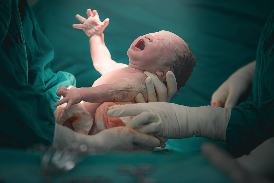 Es wird vermutet, dass viele Kaiserschnitte eher auf Personalmangel, bessere Planbarkeit und Vergütung sowie Angst vor Komplikationen zurückzuführen sind als echte medizinische Komplikationen. / Foto: Shutterstock/LittleDogKorat