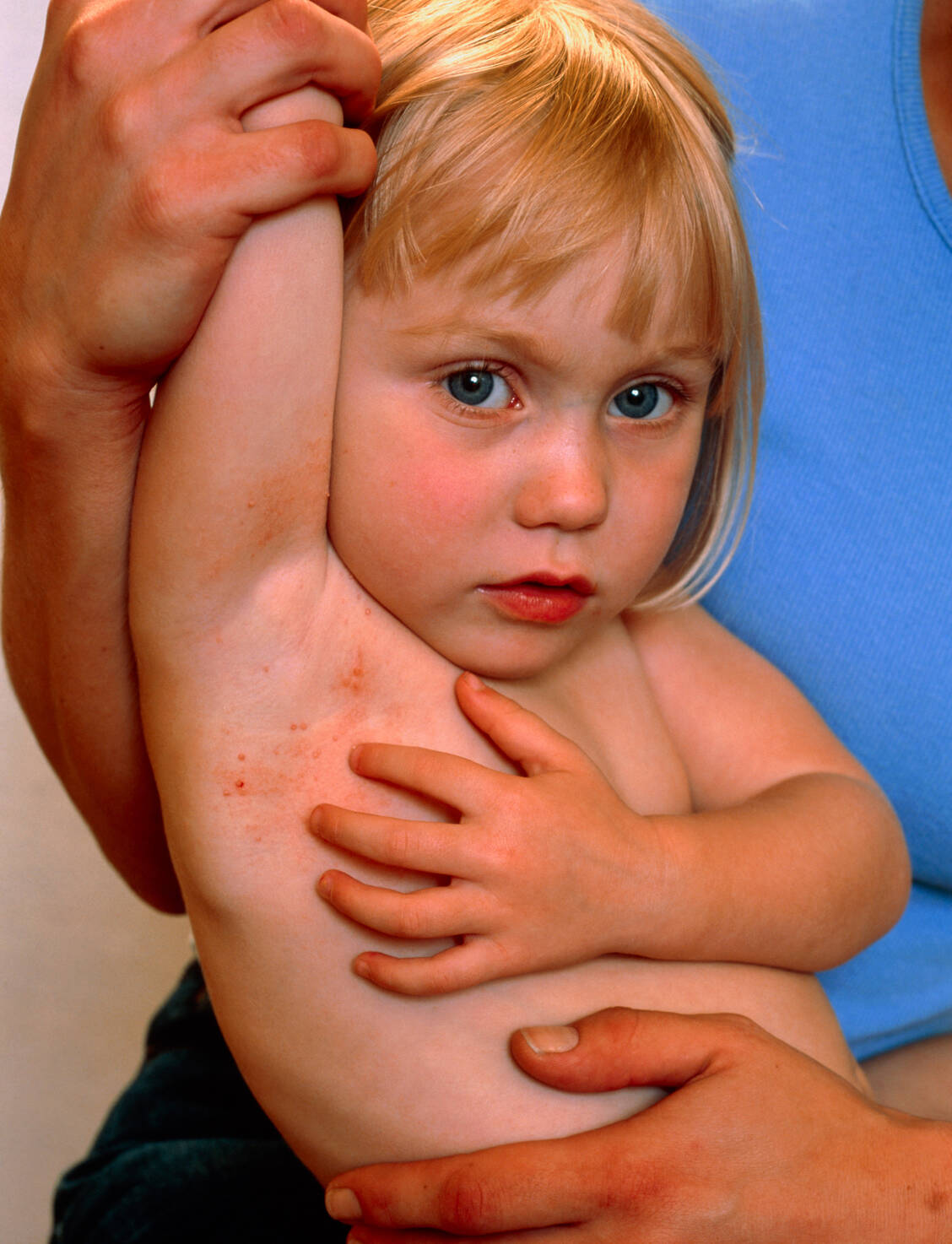 Hinter Dellwarzen steckt eine Virusinfektion der Haut, die jeden betreffen kann – meistens aber Kinder. / Foto: Science Photo Library / Young, Hattie