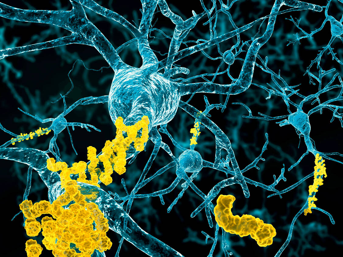 Amyloid-Plaques im Gehirn sind ein Kennzeichen der Alzheimer-Erkrankung. / Foto: Fotolia/Juan Gärtner