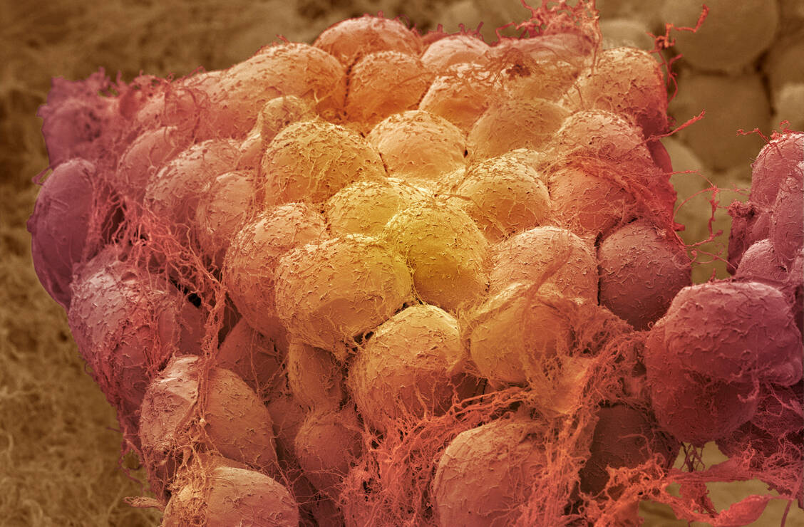 Im Fettgewebe finden permanent Entzündungsreaktionen statt, die sich negativ auf den ganzen Metabolismus auswirken können. / Foto: Getty Images/Steve Gschmeissner/Science Photo Library