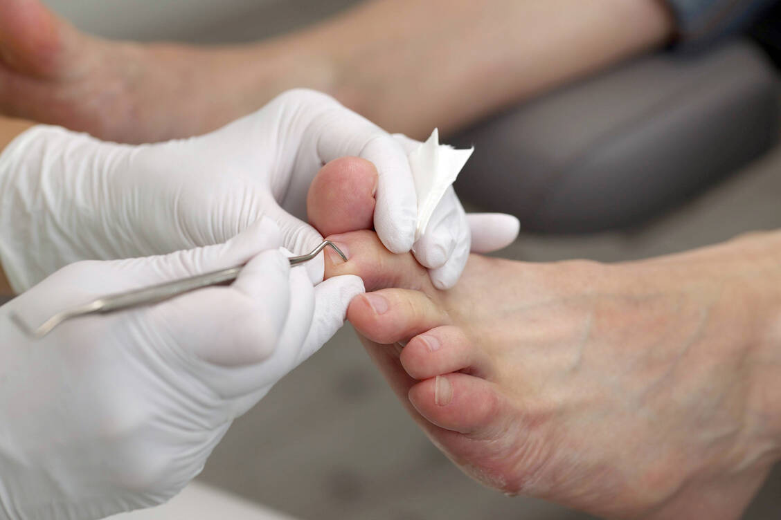 Für Patienten mit erhöhtem Risiko für das diabetische Fußsyndrom empfiehlt sich eine regelmäßige, professionelle Fußpflege. / © Imago/Joker