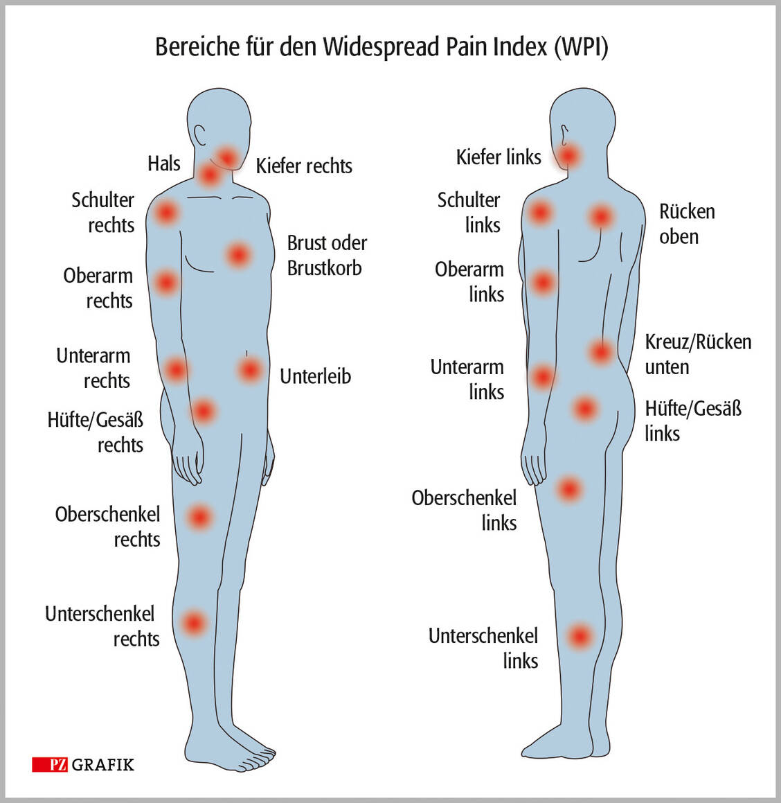 Der Widespread Pain Index (WPI) ist ein Teil der FMS-Diagnosefindung. Um ihn zu bestimmen, gibt der Patient an, in wie vielen der 19 ausgewiesenen Körperstellen er in der vergangenen Woche Schmerzen hatte. Der Wert kann zwischen 0 und 19 liegen. / © PZ-Grafik/Jens Ripperger, Adobe Stock/hiro