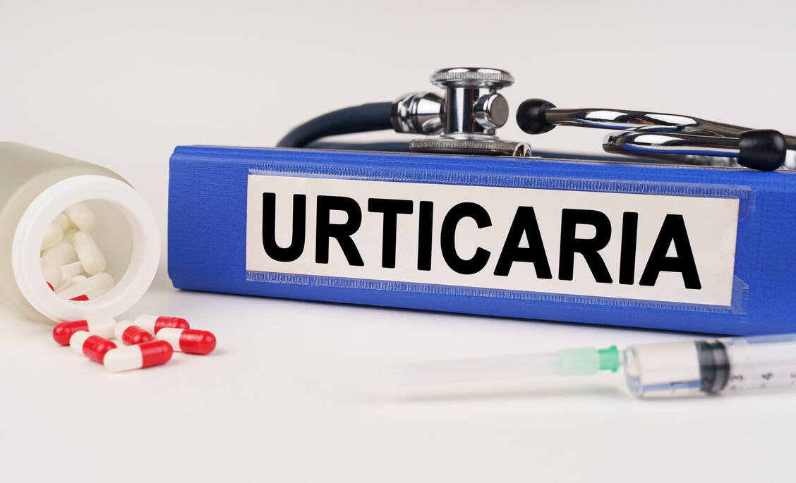 Mittel der ersten Wahl bei der Behandlung der chronischen spontanen Urtikaria sind H<sub>1</sub>-Antihistamika. Für die Zweitlinientherapie könnte eines Tages der Kinasehemmer Remibrutinib zur Verfügung stehen. Phase-III-Studienergebnisse sind vielversprechend. / Foto: Adobe Stock/Dzmitry