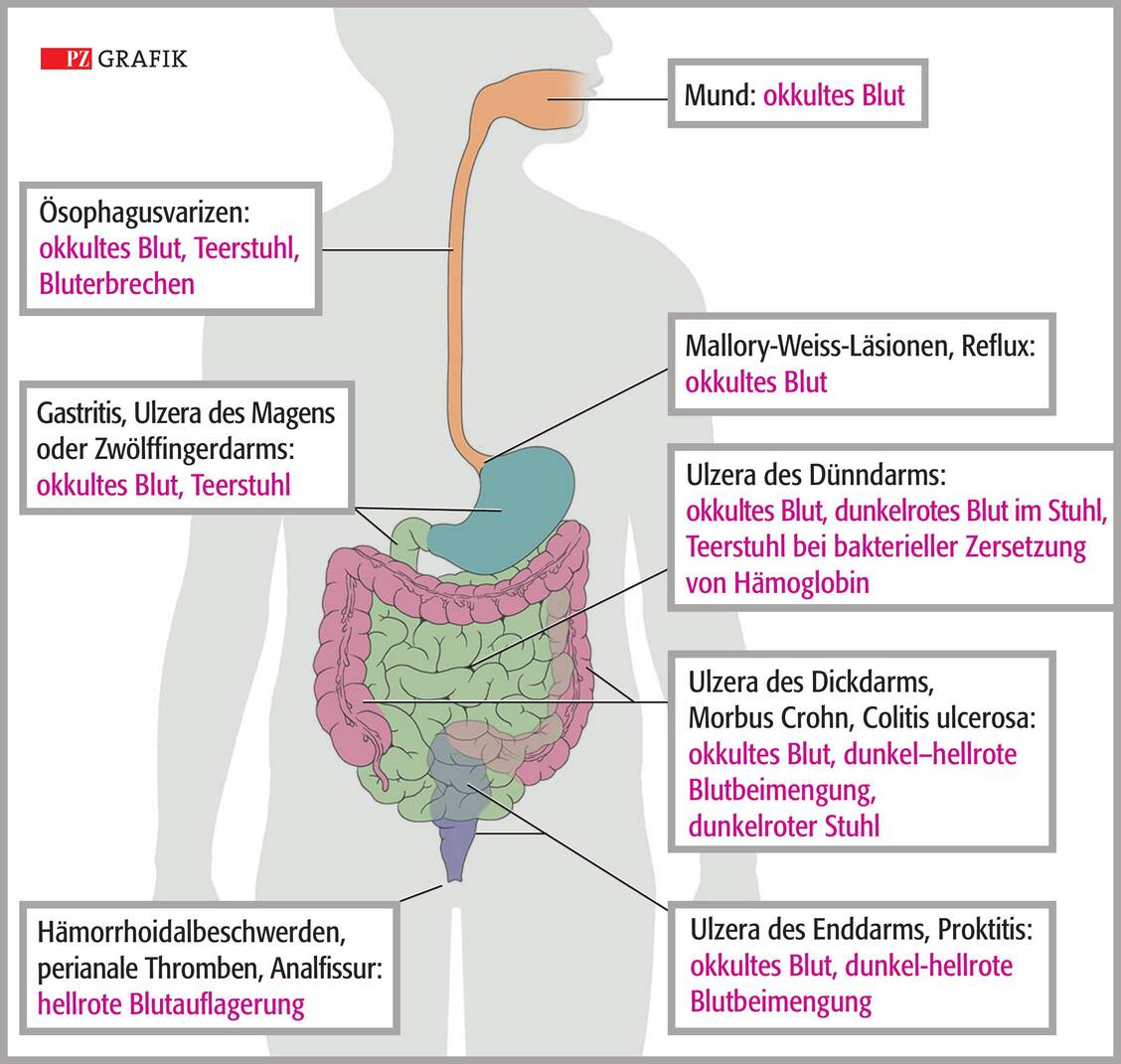 Grafik: Blutungen des Gastrointestinaltrakts und Ihre Symptomatik / © PZ/Stephan Spitzer