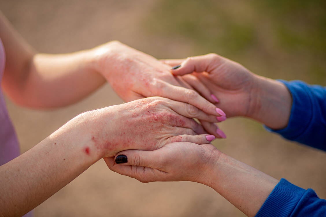 Ein stabiles Mikrobiom fängt entzündliche Hautsymptome ab: Probiotische Hautpflege stellt einen vielversprechenden Ansatz in der Neurodermitis-Therapie dar. / © Getty Images/Irina Esau