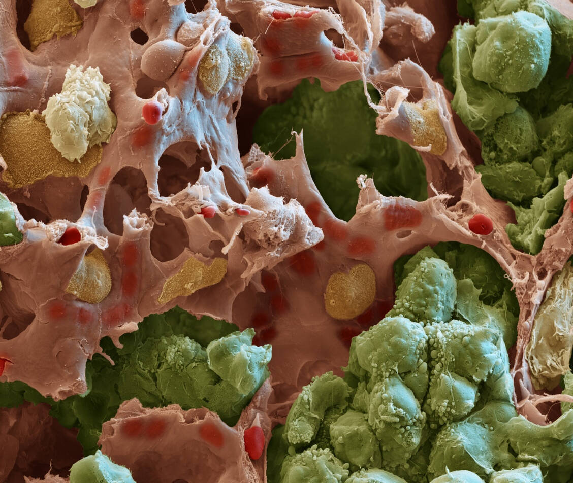 Farblich animierte 3D-Darstellung einer Metastase in der Lunge einer Maus. Die Tumorzellen sind grün gefärbt, pink das verbliebene Lungengewebe. / Foto: DKFZ/Augustin; Eye of Science/Meckes