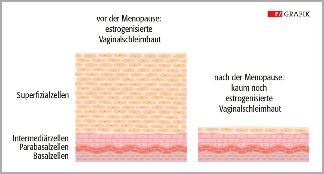Der Unterschied ist deutlich: Das nicht verhornte Plattenepithel der Vaginalschleimhaut ist vor der Menopause mit einer üppigen Schicht von Superfizialzellen ausgestattet. Sinken die Estrogenspiegel, schwinden die Superfizialzellen, was die Vaginalschleimhaut pergament­artig und entzündungsanfällig werden lässt. / © PZ/Ripperger